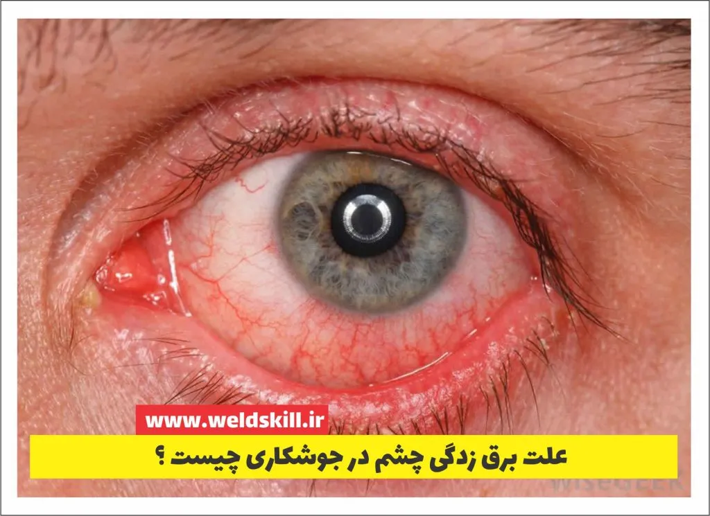 علت برق زدگی چشم در جوشکاری چیست