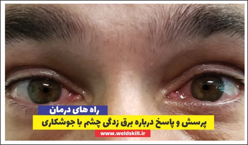 پرسش و پاسخ درباره برق زدگی چشم با جوشکاری