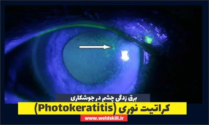 کراتیت نوری (Photokeratitis)