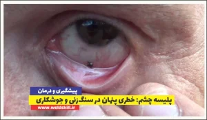 پلیسه چشم خطری پنهان در سنگ‌زنی و جوشکاری