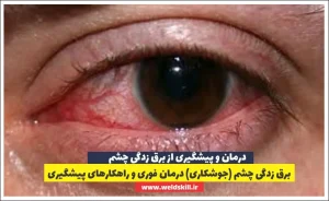 برق زدگی چشم (جوشکاری) درمان فوری و راهکارهای پیشگیری