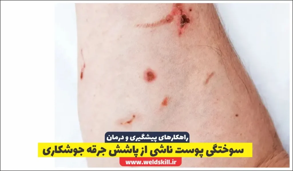 سوختگی پوست ناشی از پاشش جرقه جوشکاری