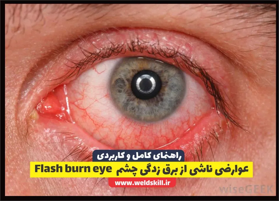 عوارضی ناشی از برق زدگی چشم Flash burn eye